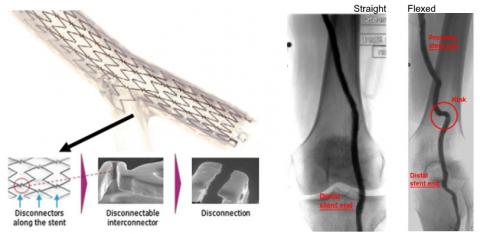 Image of the Stentys coronary bifurcation stent