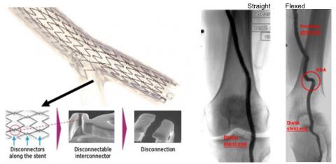 Image of the Stentys coronary bifurcation stent 